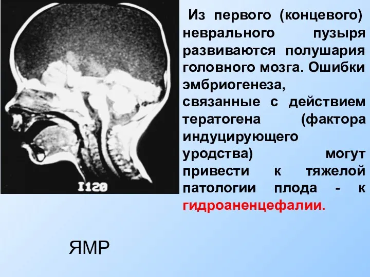 Из первого (концевого) неврального пузыря развиваются полушария головного мозга. Ошибки