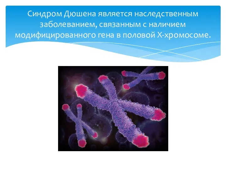 Синдром Дюшена является наследственным заболеванием, связанным с наличием модифицированного гена в половой Х-хромосоме.