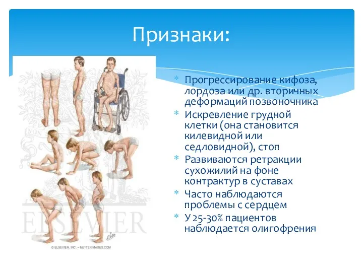 Признаки: Прогрессирование кифоза, лордоза или др. вторичных деформаций позвоночника Искревление