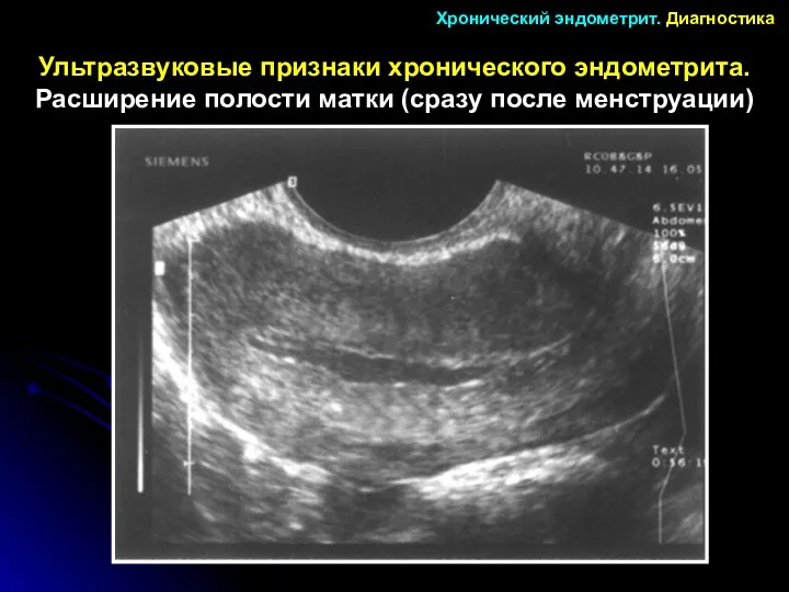 Ультразвуковые признаки хронического эндометрита. Расширение полости матки (сразу после менструации) Хронический эндометрит. Диагностика