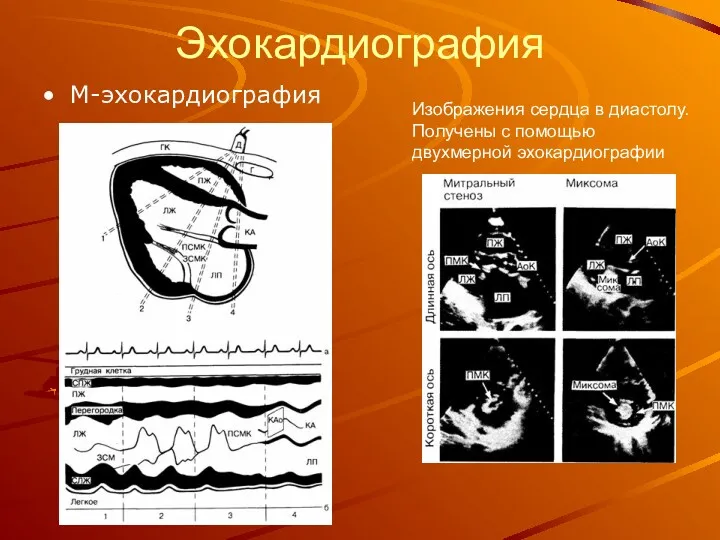 Эхокардиография М-эхокардиография Изображения сердца в диастолу. Получены с помощью двухмерной эхокардиографии