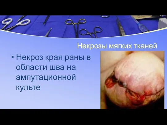 Некрозы мягких тканей Некроз края раны в области шва на ампутационной культе