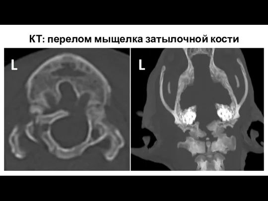 КТ: перелом мыщелка затылочной кости