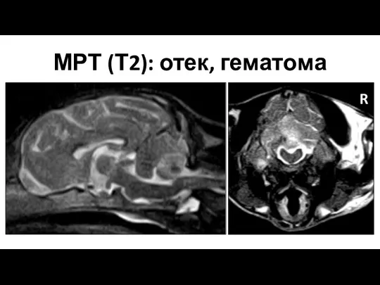 МРТ (Т2): отек, гематома