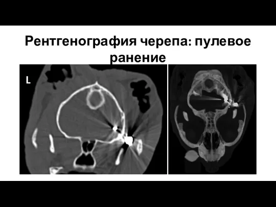 Рентгенография черепа: пулевое ранение