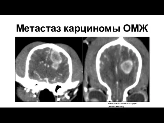 Метастаз карциномы ОМЖ иногда вызывают острую симптоматику