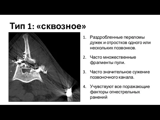 Тип 1: «сквозное» Раздробленные переломы дужек и отростков одного или нескольких позвонков. Часто