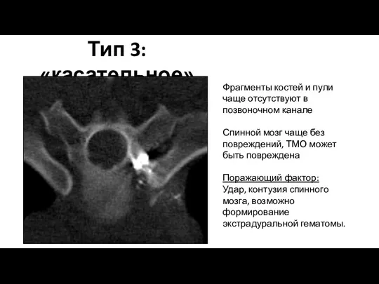 Тип 3: «касательное» Фрагменты костей и пули чаще отсутствуют в позвоночном канале Спинной