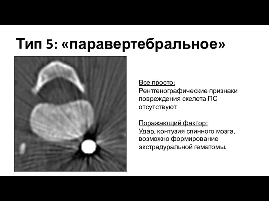 Тип 5: «паравертебральное» Все просто: Рентгенографические признаки повреждения скелета ПС отсутствуют Поражающий фактор: