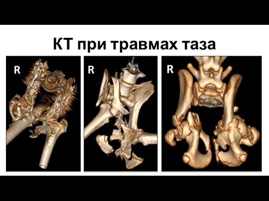 КТ при травмах таза