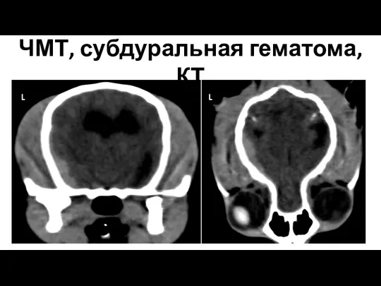 ЧМТ, субдуральная гематома, КТ L L