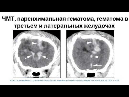 ЧМТ, паренхимальная гематома, гематома в третьем и латеральных желудочах Wisner