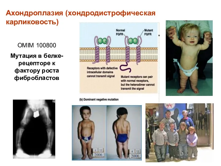 Ахондроплазия (хондродистрофическая карликовость) OMIM 100800 Мутация в белке-рецепторе к фактору роста фибробластов