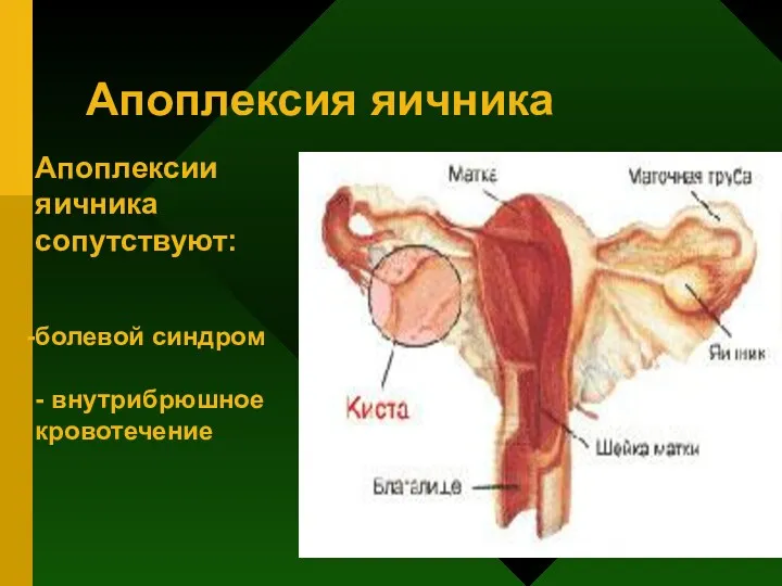 Апоплексия яичника Апоплексии яичника сопутствуют: болевой синдром - внутрибрюшное кровотечение