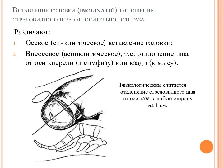 Вставление головки (inclinatio)-отношение стреловидного шва относительно оси таза. Различают: Осевое