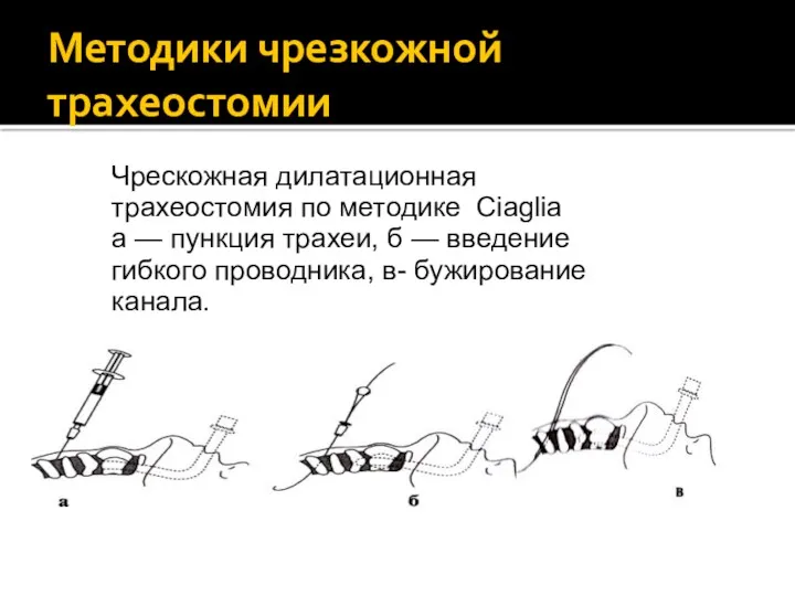 Методики чрезкожной трахеостомии Чрескожная дилатационная трахеостомия по методике Ciaglia а — пункция трахеи,