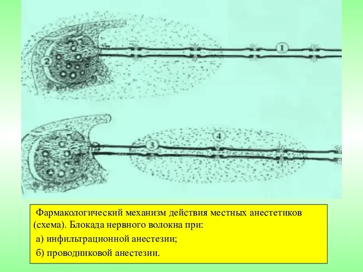 Фармакологический механизм действия местных анестетиков (схема). Блокада нервного волокна при: а) инфильтрационной анестезии; б) проводниковой анестезии.