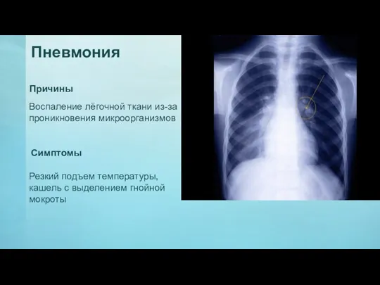 Пневмония Причины Воспаление лёгочной ткани из-за проникновения микроорганизмов Симптомы Резкий подъем температуры, кашель