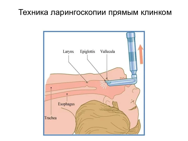 Техника ларингоскопии прямым клинком