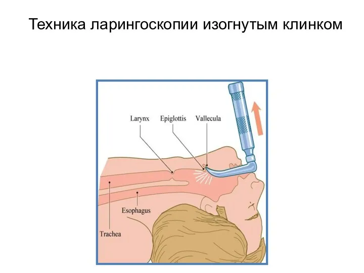 Техника ларингоскопии изогнутым клинком