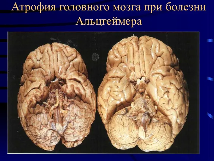 Атрофия головного мозга при болезни Альцгеймера