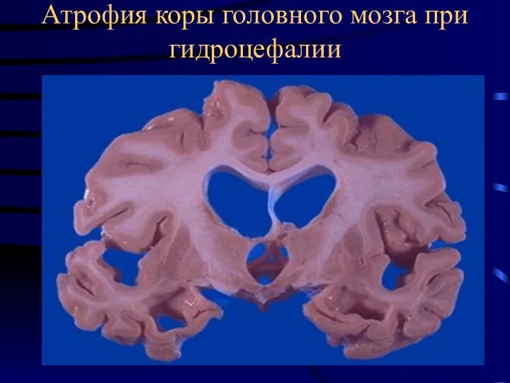 Атрофия коры головного мозга при гидроцефалии