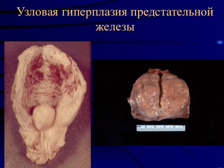 Узловая гиперплазия предстательной железы