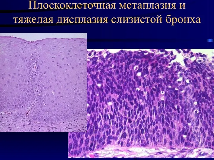 Плоскоклеточная метаплазия и тяжелая дисплазия слизистой бронха