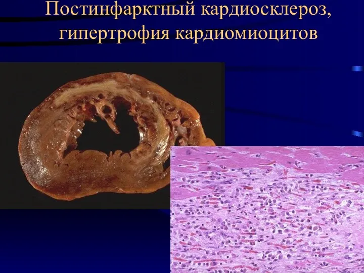 Постинфарктный кардиосклероз, гипертрофия кардиомиоцитов