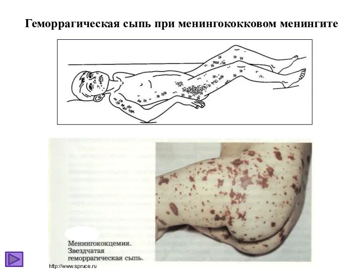 Геморрагическая сыпь при менингококковом менингите http://www.spruce.ru