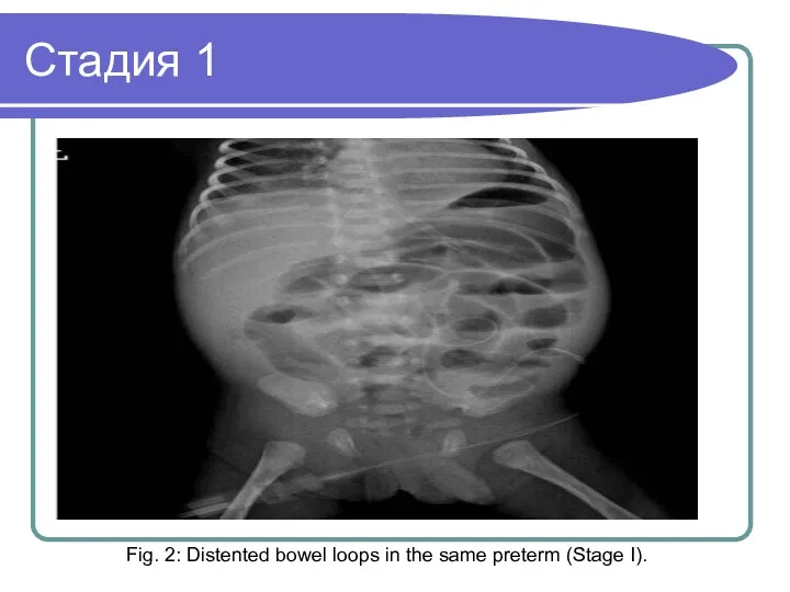 Стадия 1 Fig. 2: Distented bowel loops in the same preterm (Stage I).