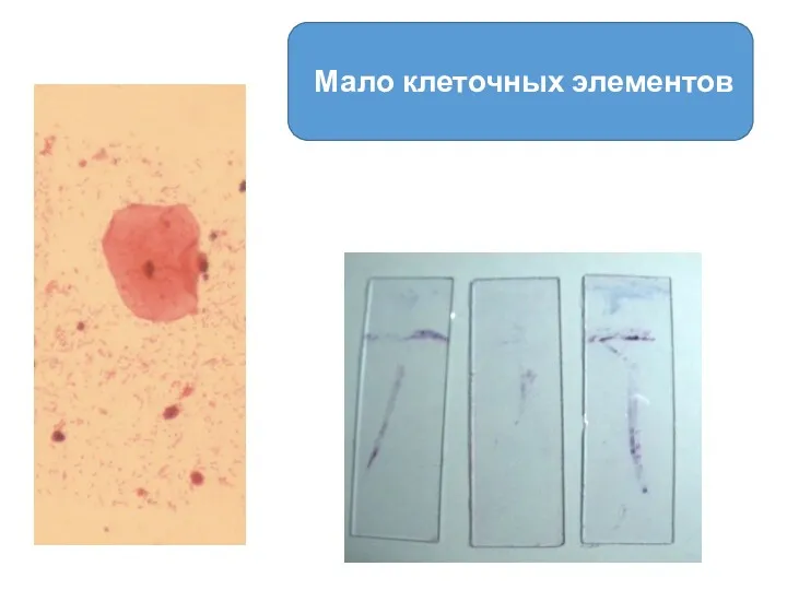 Мало клеточных элементов