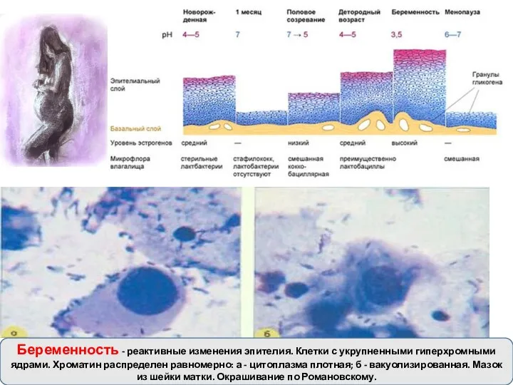 Беременность - реактивные изменения эпителия. Клетки с укрупненными гиперхромными ядрами.