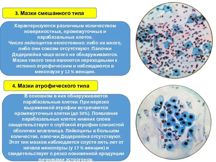 Характеризуются различным количеством поверхностных, промежуточных и парабазальных клеток. Число лейкоцитов