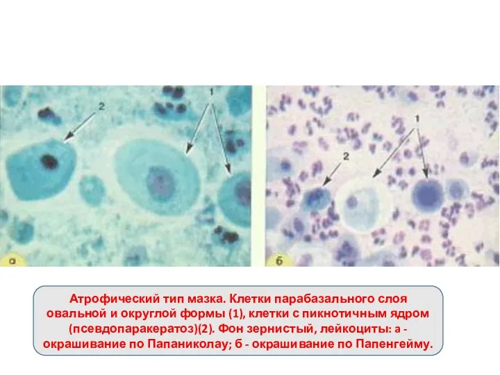 Атрофический тип мазка. Клетки парабазального слоя овальной и округлой формы