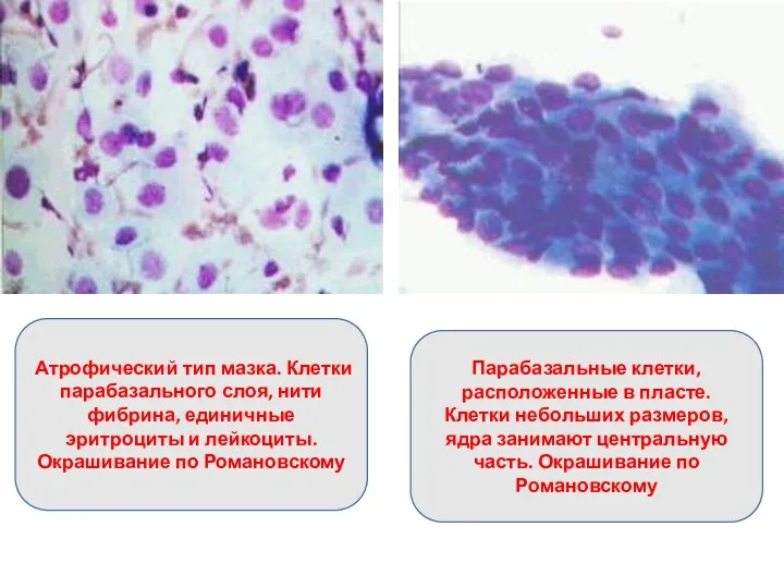 Атрофический тип мазка. Клетки парабазального слоя, нити фибрина, единичные эритроциты