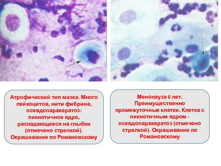Атрофический тип мазка. Много лейкоцитов, нити фибрина, псевдопаракератоз: пикнотичное ядро,