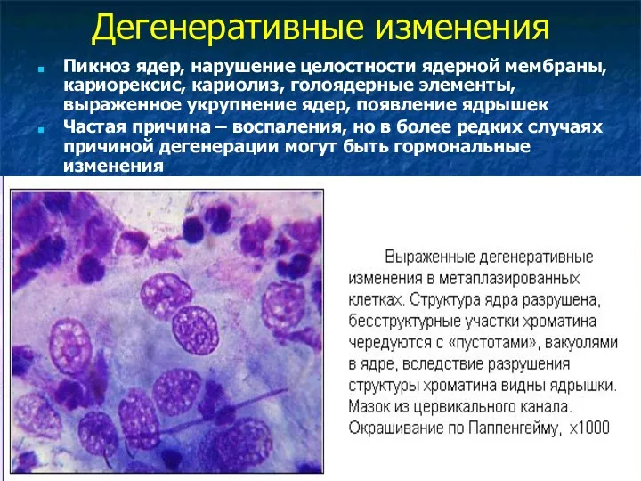 Дегенеративные изменения Пикноз ядер, нарушение целостности ядерной мембраны, кариорексис, кариолиз,