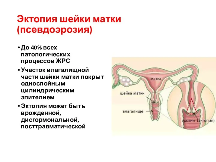 Эктопия шейки матки (псевдоэрозия) До 40% всех патологических процессов ЖРС