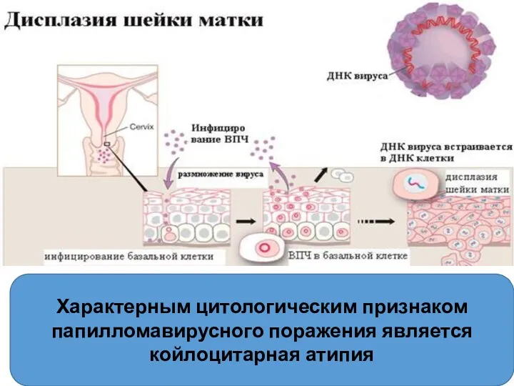 Характерным цитологическим признаком папилломавирусного поражения является койлоцитарная атипия