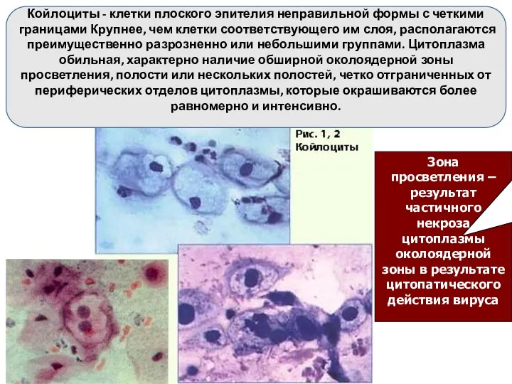 Койлоциты - клетки плоского эпителия неправильной формы с четкими границами