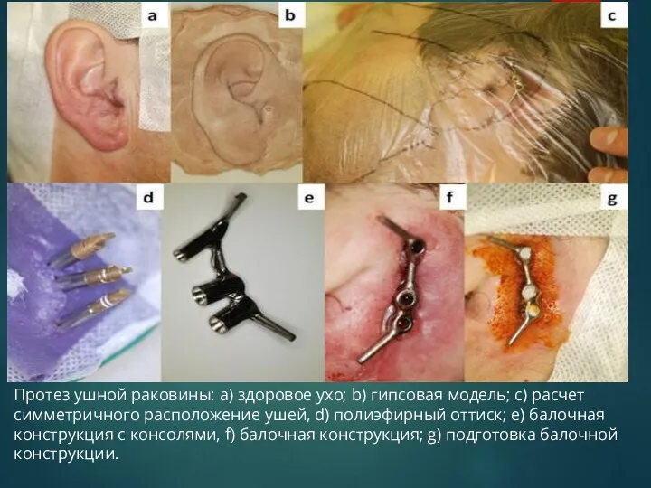 Протез ушной раковины: a) здоровое ухо; b) гипсовая модель; c)