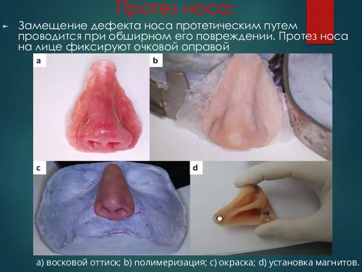 Протез носа: Замещение дефекта носа протетическим путем проводится при обширном