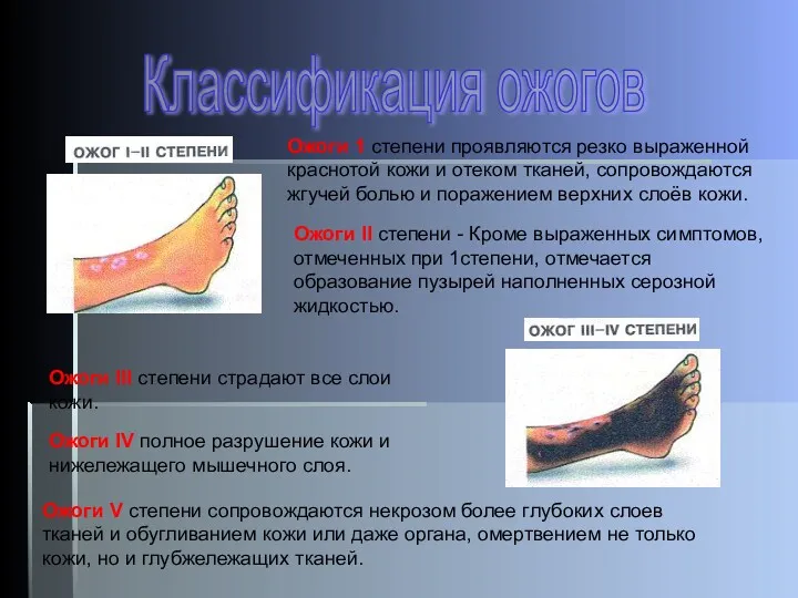 Ожоги 1 степени проявляются резко выраженной краснотой кожи и отеком