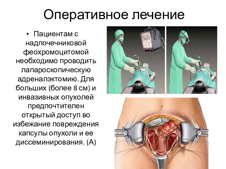 Оперативное лечение Пациентам с надпочечниковой феохромоцитомой необходимо проводить лапароскопическую адреналэктомию.