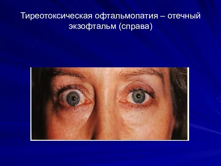 Тиреотоксическая офтальмопатия – отечный экзофтальм (справа)