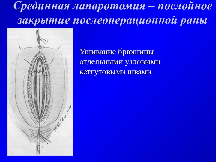 Срединная лапаротомия – послойное закрытие послеоперационной раны Ушивание брюшины отдельными узловыми кетгутовыми швами