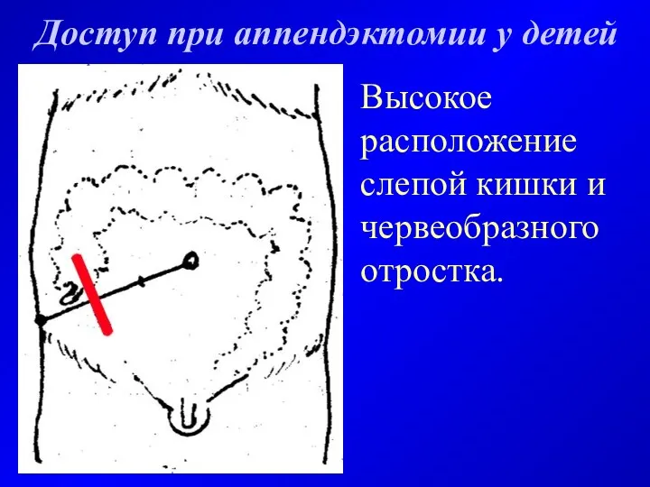 Доступ при аппендэктомии у детей Высокое расположение слепой кишки и червеобразного отростка.