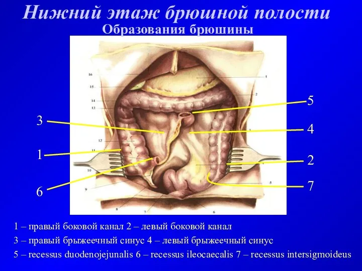 Нижний этаж брюшной полости Образования брюшины 1 – правый боковой канал 2 –