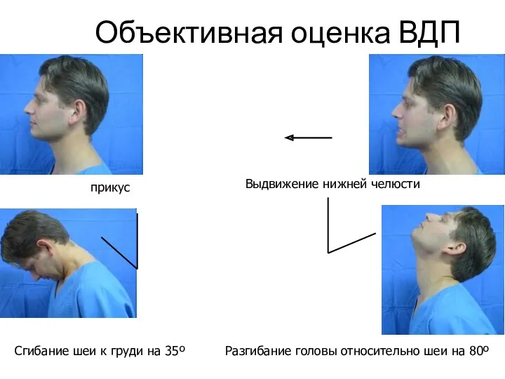 Объективная оценка ВДП прикус Выдвижение нижней челюсти Разгибание головы относительно